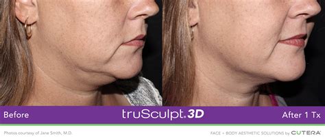 trusculpt 3d near me.